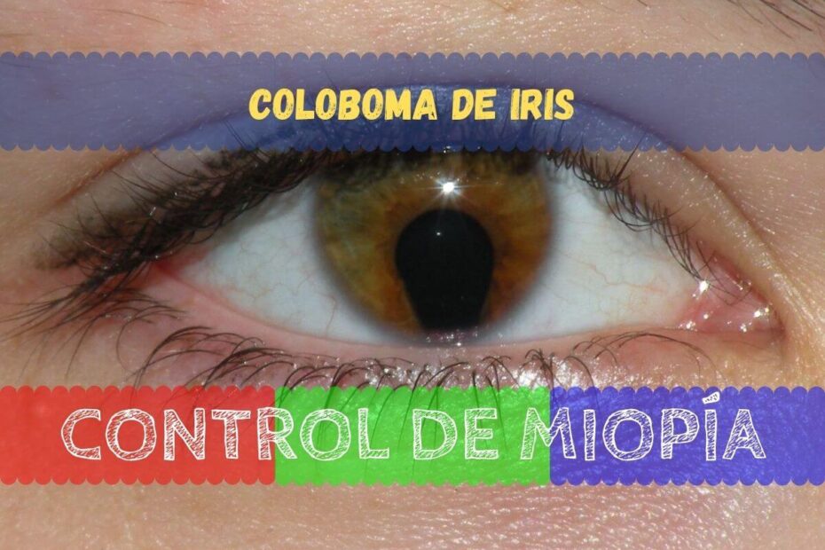 Coloboma De Iris 1ºer Contacto Control De Miopia 6643