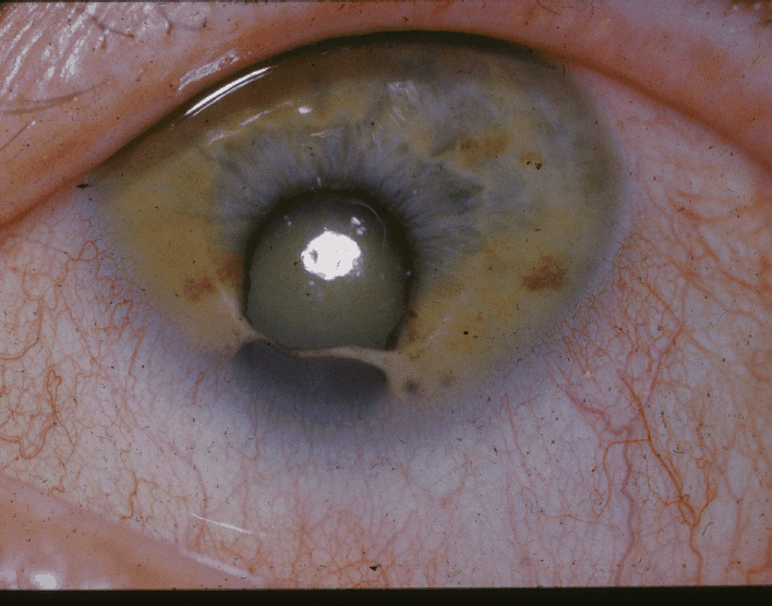 Coloboma de iris 1