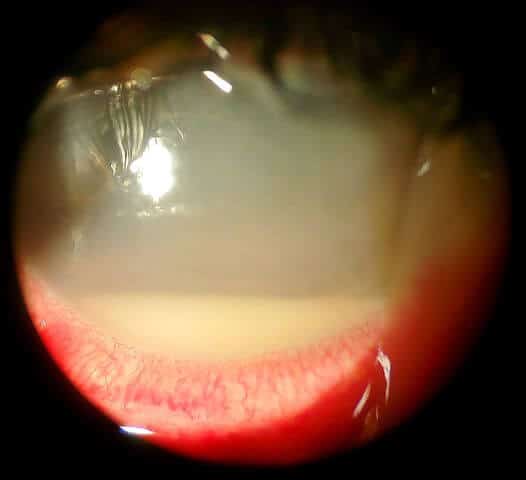 Hypopyon from the wikipedia commons, ilustrating the pathology. Hipopion en un ojo patológico, se nota la pérdida de transparencia en la córnea del paciente.