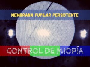 Banner - Membrana Pupilar Persistente en humanos