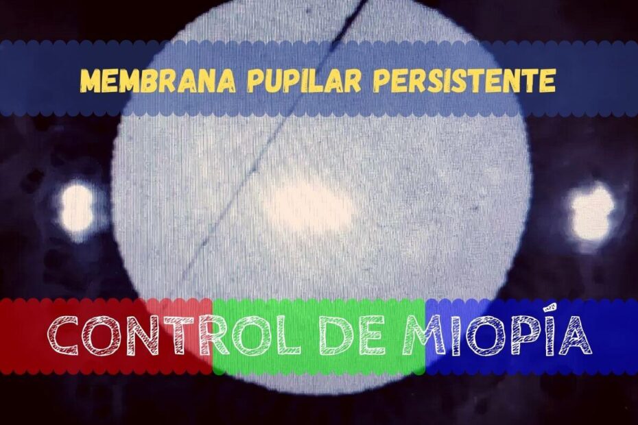 Membrana pupilar persistente 1 Banner - Membrana Pupilar Persistente en humanos